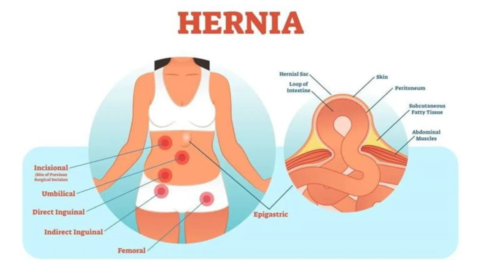 What Does a Hernia Feel Like